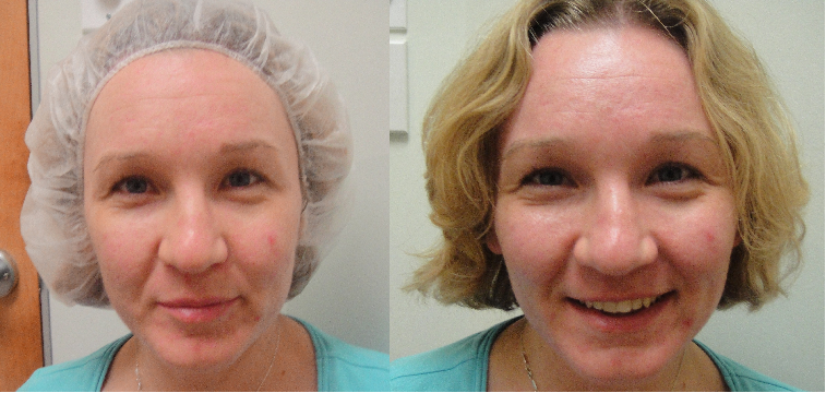 Microdermabrasion has been proved to 