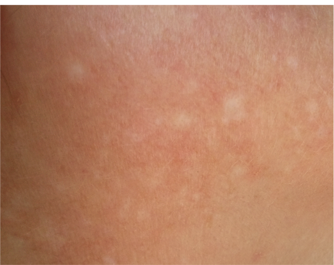 Skin Discoloration Patch